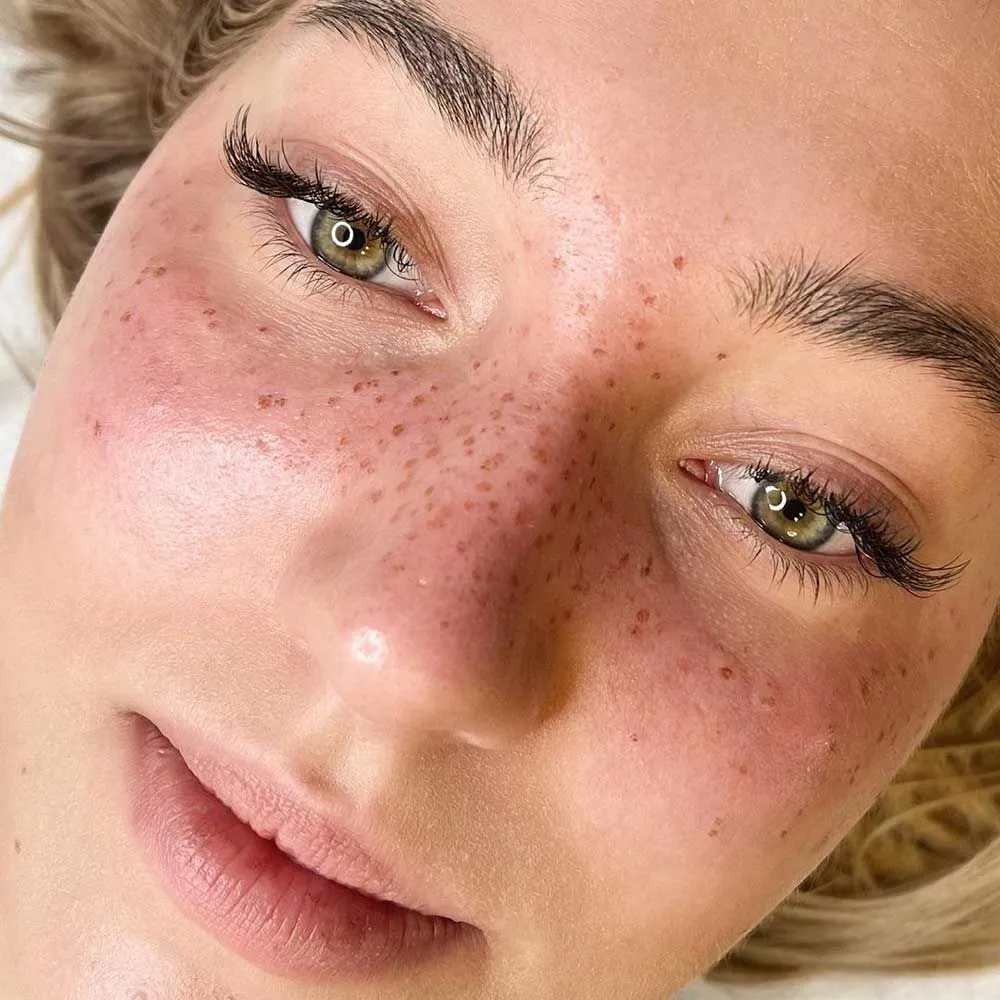 Freckles Sommersprossen Ergebnis München